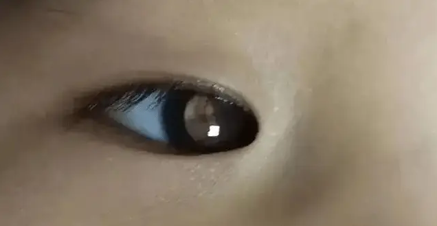 儿童“美丽的”猫眼，背后隐藏着怎样的可怕？